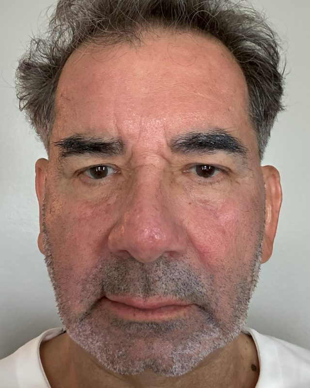 After photo of patient's skin following HALO TRIBRID treatment