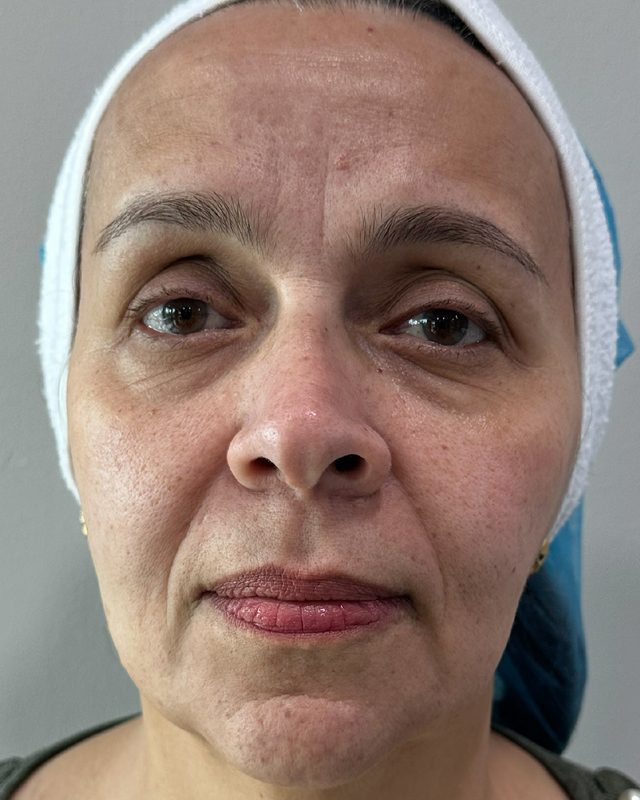 Before photo of patient's skin