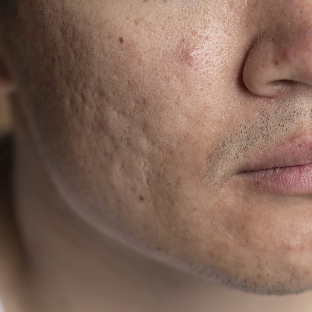 Close-up of skin showing acne scars